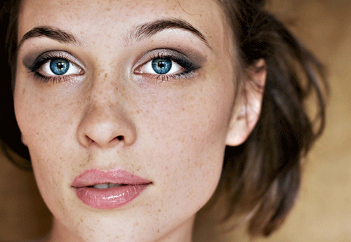 Tàn nhang thường xuất hiện tại những vùng da mỏng: quanh mắt, má, cổ...