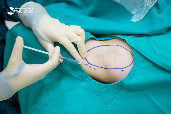 Tiêm dung dịch trị hôi nách là phương pháp điều trị hôi nách không đau, không để lại sẹo, thời gian thực hiện nhanh chóng