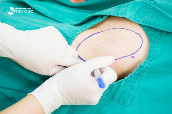 Khách hàng được gây tê cục bộ và được các bác sĩ tiến hành đo vẽ cẩn thận để vết mổ chính xác nhất
