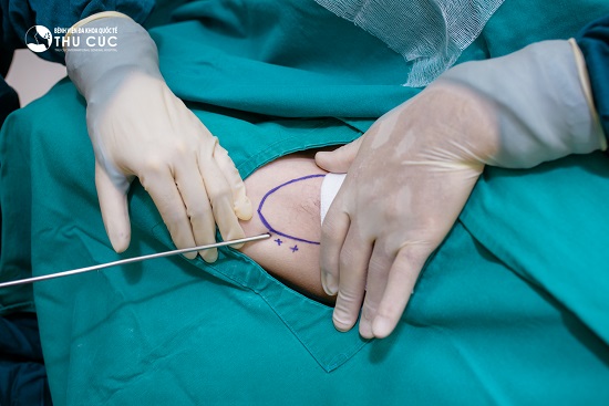 Hút tuyến mồ hôi bằng công nghệ Vaser Lipo mang lại hiệu quả vượt trội