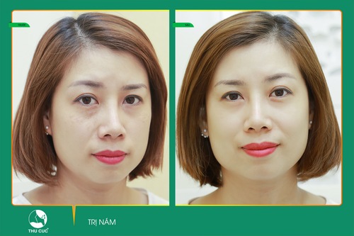 trị nám