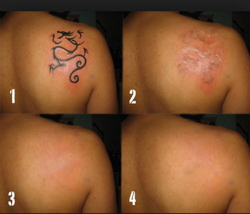 xoa-hinh-xam-bang-laser