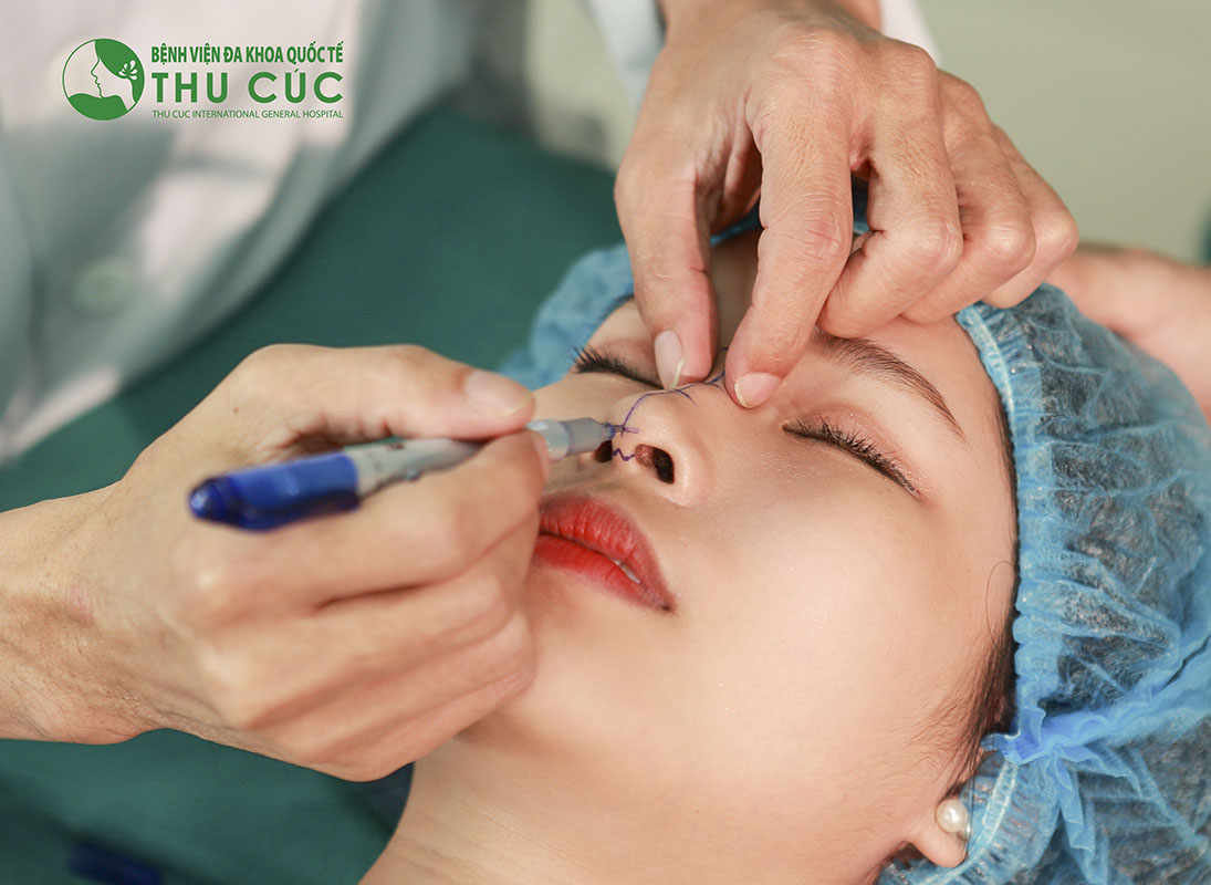 Nâng mũi bọc sụn