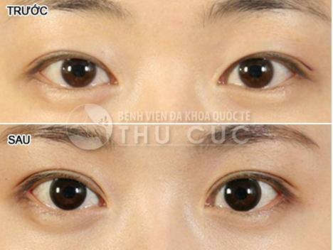 Sau phẫu thuật, góc mắt được mở rộng trở nên to, long lanh và tràn đầy sức sống