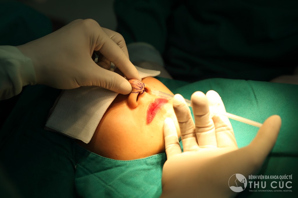 Khi thực hiện, bác sĩ sẽ tiêm chất làm đầy vào vùng sống mũi, khéo léo nắn chỉnh định hình form cho sống mũi.