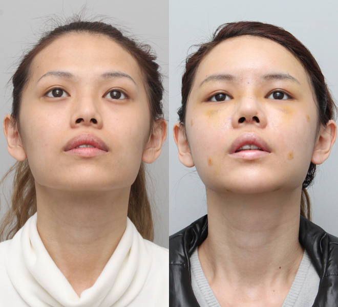 Bạn có thể thấy rõ sự khác biệt về kích thước sau khi phẫu thuật, lỗ mũi hình hạt chanh đẹp hài hòa.