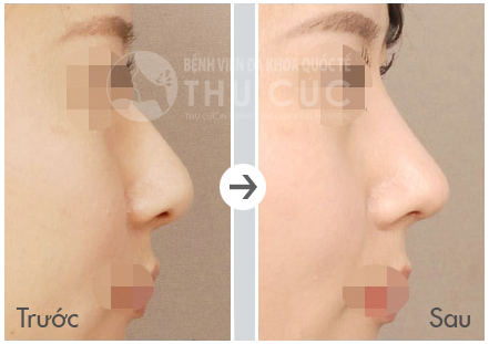 Nâng mũi S line bao gồm cấu trúc còn dựng lại cả phần đầu mũi, vách ngăn, cấu trúc lại toàn bộ để mũi cân xứng, hoàn hảo nhất.
