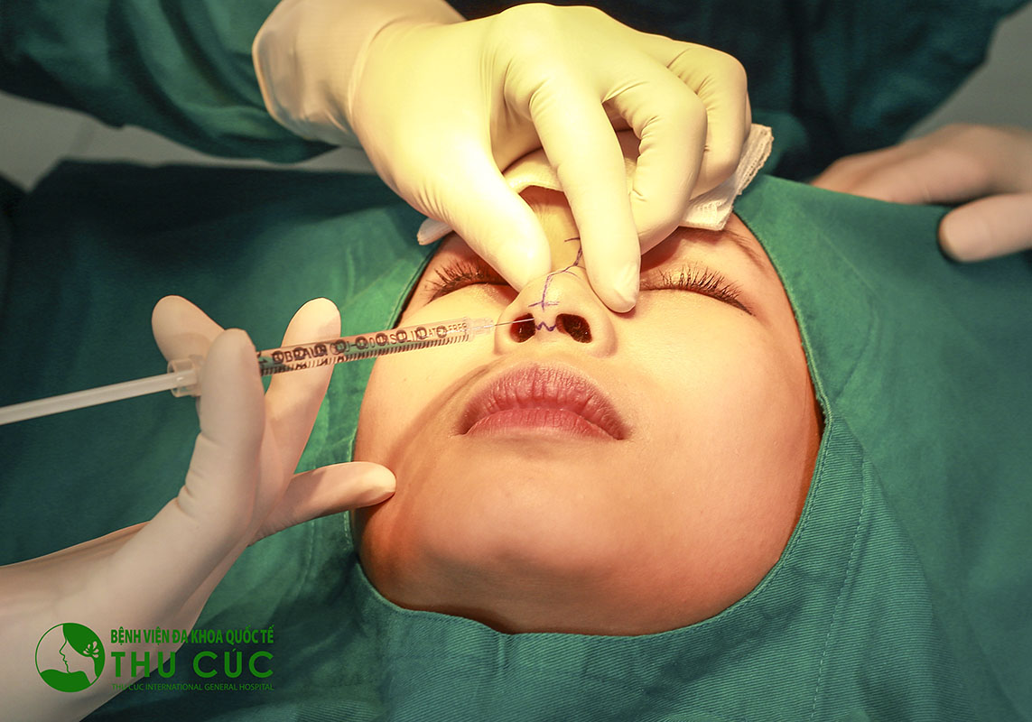 Nâng mũi không phẫu thuật tại Thu Cúc Sài Gòn  an toàn, mang lại hiệu quả thẩm mỹ cao.