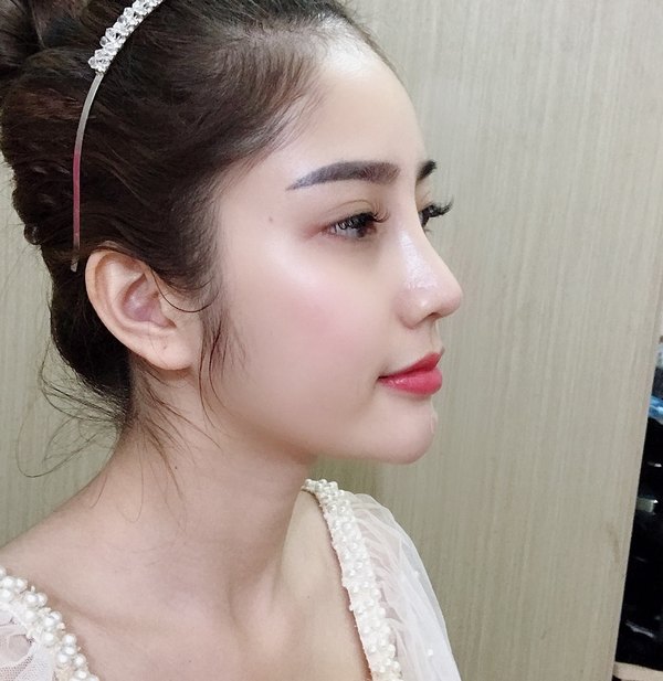 Dáng mũi đẹp hoàn hảo ở góc nghiêng của khách hàng sau khi nâng mũi tại Thu Cúc