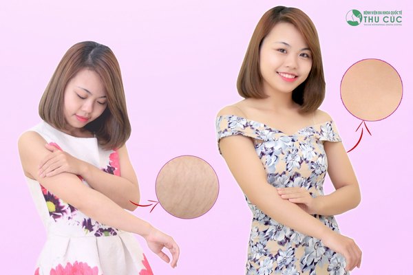 Làn da sau khi triệt lông sẽ mềm mịn, tươi trẻ hơn (Lưu ý: Kết quả tùy thuộc cơ địa mỗi người)