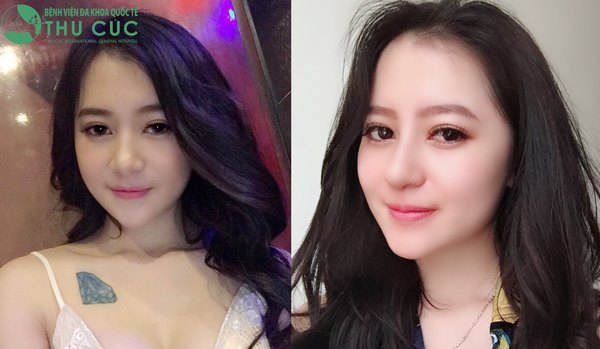 Chỉ sau khoảng 30' thực hiện khách hàng sẽ sở hữu dáng mũi đẹp như ý (Lưu ý: Kết quả tùy thuộc cơ địa mỗi người)