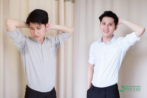 Hiệu quả điều trị hôi nách sẽ thấy rõ ngay sau khi phẫu thuật hoàn thành (Lưu ý: Kết quả tùy thuộc cơ địa mỗi người)