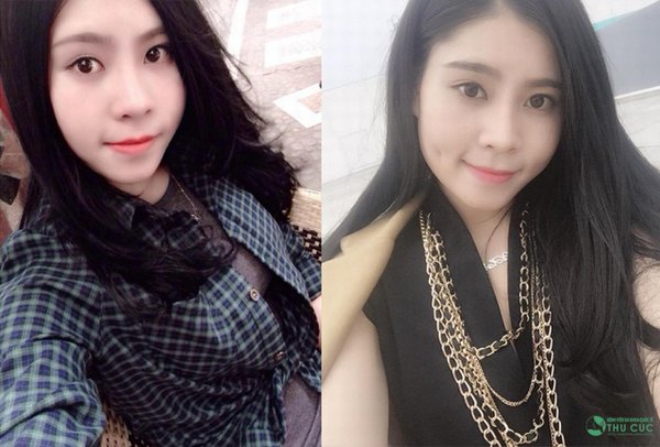 Chỉ sau phẫu thuật 1 thời gian ngắn khách hàng sẽ sở hữu má lúm tự nhiên như ý (Lưu ý: Kết quả tùy thuộc cơ địa mỗi người)