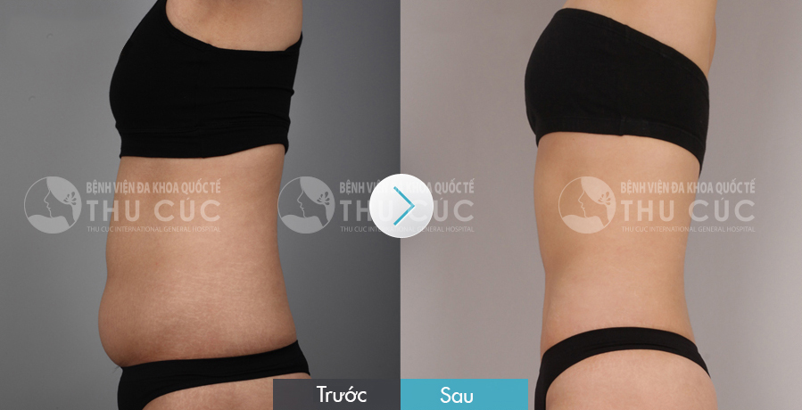 Kết quả hút mỡ bằng Vaser Lipo tại Thu Cúc Sài Gòn