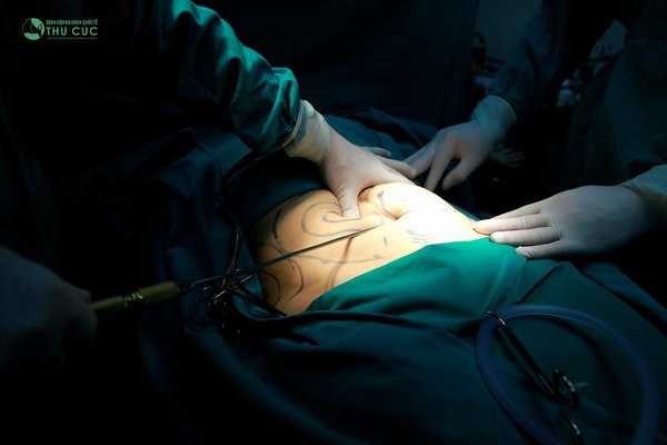 Vaser Lipo là công nghệ giảm mỡ được yêu thích số 1 hiện nay