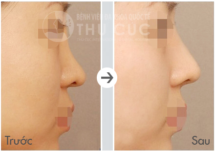Bạn có thể an tâm, thoải mái tận hưởng chiếc mũi cao thẳng, thon gọn, không lộ dấu vết thẩm mỹ hay hoàn toàn không có vết sẹo sau khi nâng mũi bọc sụn
