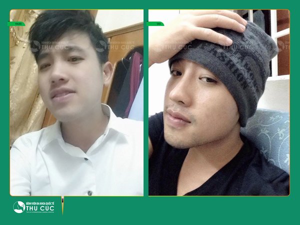 Thu Cúc cam kết bảo hành lâu dài cho dịch vụ nâng mũi (Lưu ý: Kết quả tùy thuộc cơ địa mỗi người)