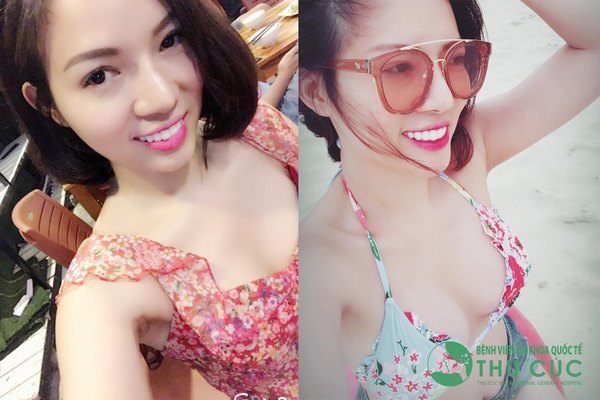 Thời gian hồi phục sau khi nâng ngực nội soi tại Thu Cúc rất nhanh chóng (Lưu ý: Kết quả tùy thuộc cơ địa mỗi người)