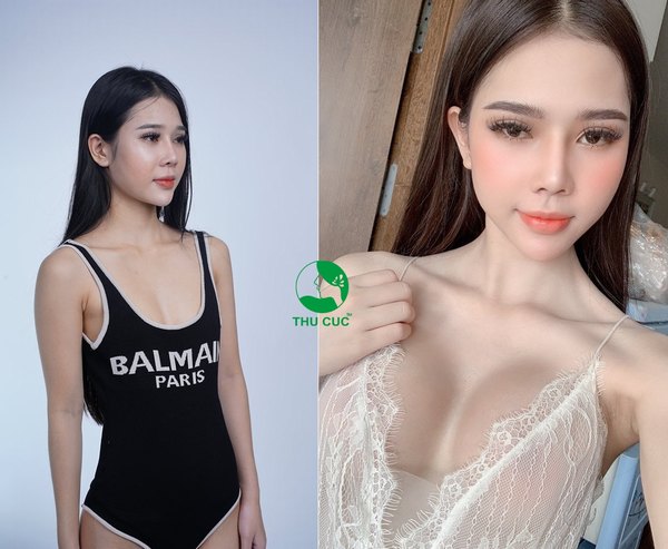 Khuôn ngực sau khi thẩm mỹ tự nhiên như thật và hài hòa tuyệt đối với cơ thể