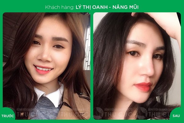 Dáng mũi của khách hàng sau khi nâng mũi Hàn Quốc tự nhiên và hài hòa với gương mặt (Lưu ý: Kết quả tùy thuộc vào cơ địa mỗi người)