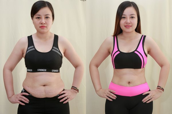 Thu Cúc đã giúp hàng nghìn khách hàng đánh bật mỡ thừa sau 1 lần thực hiện duy nhất (Lưu ý: Kết quả tùy thuộc cơ địa mỗi người)