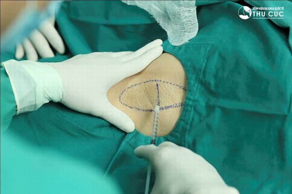 Chi phí điều trị hôi nách phụ thuộc vào phương pháp mà bạn lựa chọn