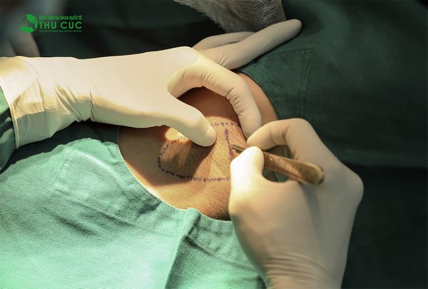 Công nghệ điều trị hôi nách tại Thu Cúc cho hiệu quả điều trị lên đến 95%