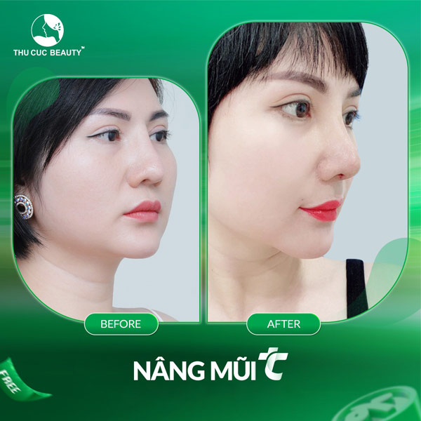 Những câu hỏi thường gặp về nâng mũi bọc sụn