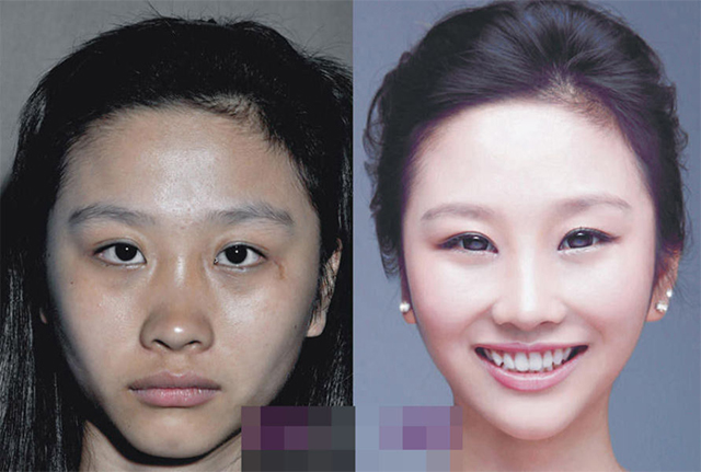 Wangchen Chen đã trải qua phẫu thuật tái tạo mũi, không thể phủ nhận rằng Chen của ngày hôm nay đẹp hơn, hấp dẫn hơn.