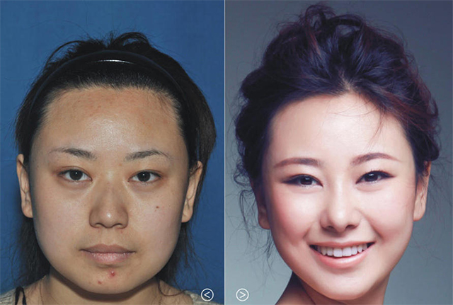 Hình ảnh trên là của một 26 tuổi có tên là Yumei Xe. Những hình ảnh trên bên phải cho thấy cô sau khi nâng mũi, hút mỡ trên khuôn mặt thì các đường nét đẹp được tôn lên, giúp khuôn mặt trông rạng rỡ và thanh thoát.