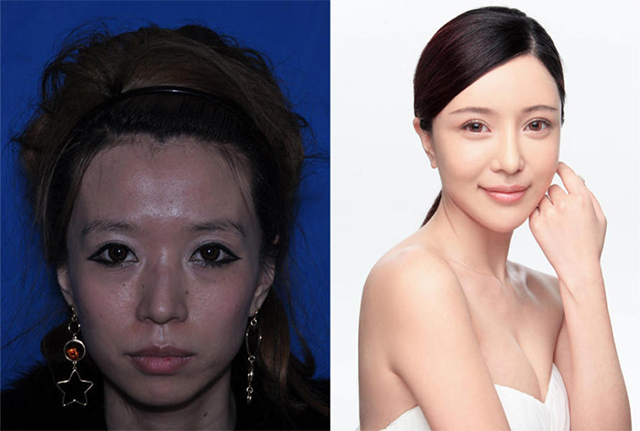 Zhang Cher là một phụ nữ 27 tuổi ở Trùng Khánh, Trung Quốc và đang là ca sĩ triển vọng. Zhang đã quyết định phẫu thuật để sửa đi chiếc mũi gồ của mình. Sau khi sửa mũi, loại bỏ tàn nhang bằng laser, trông cô như biến đổi  thành con người khác, đẹp hơn, quyến rũ hơn.