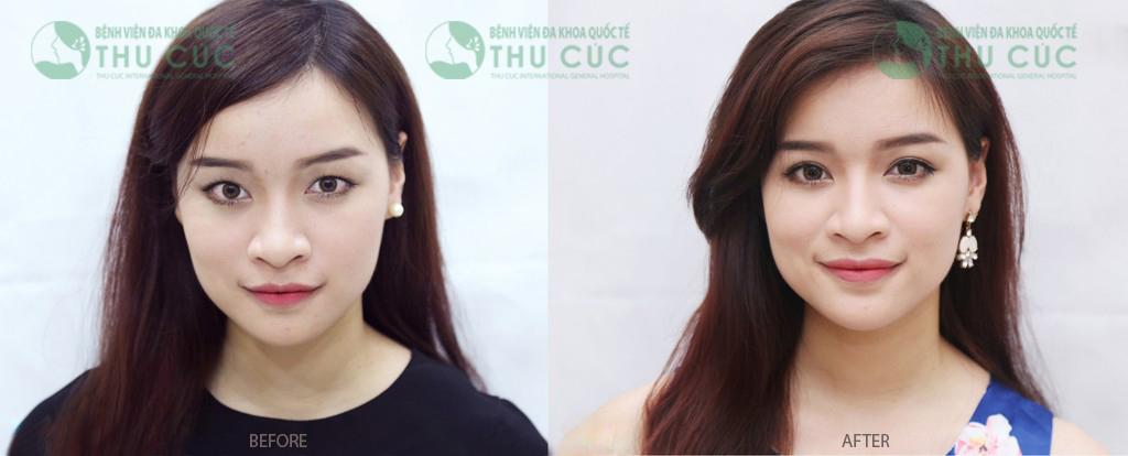 Địa chỉ cắt mí mắt đẹp nhất Sài Gòn