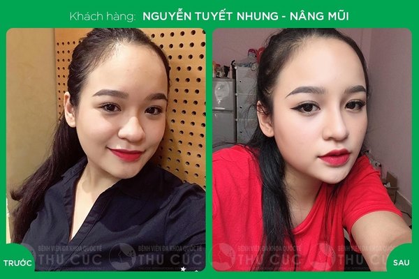Sự thay đổi ở dáng mũi giúp chị em trở nên xinh đẹp, nổi bật hơn (Lưu ý: Kết quả tùy thuộc cơ địa mỗi người)