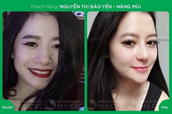 Một chút thay đổi ở dáng mũi đã giúp chị em xinh đẹp và nổi bật hơn hẳn (Lưu ý: Kết quả tùy thuộc cơ địa mỗi người)