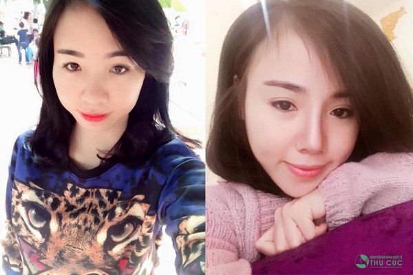 Thu Cúc cam kết bảo hành lâu dài cho dịch vụ (Lưu ý: Kết quả tùy thuộc cơ địa mỗi người)