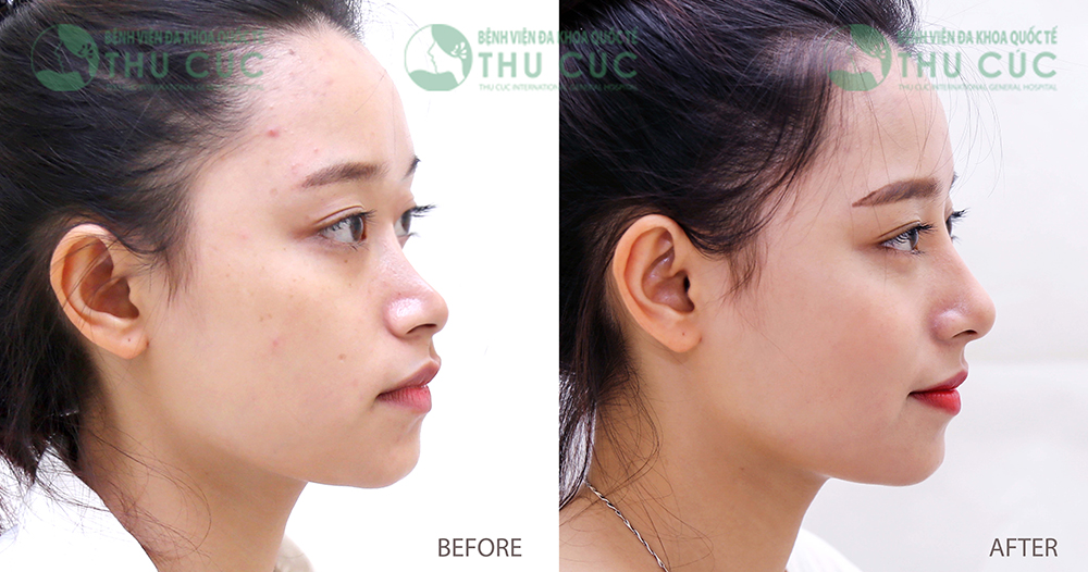 Nhận biết địa chỉ nâng mũi S line đẹp nhất TP.HCM