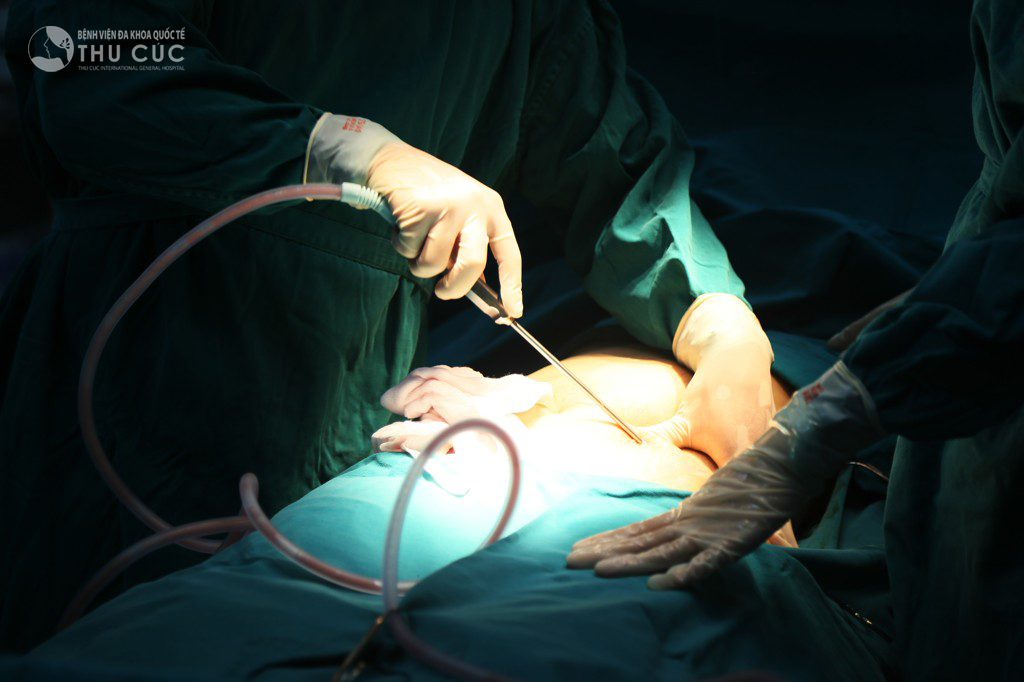 Nâng ngực bằng mỡ tự thân ở Đồng Nai