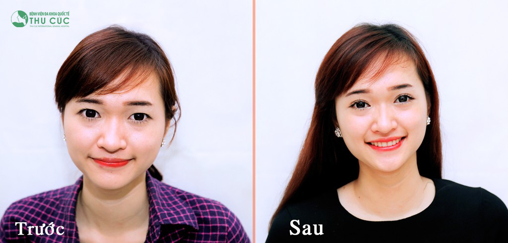 bấm mí mắt Hàn Quốc