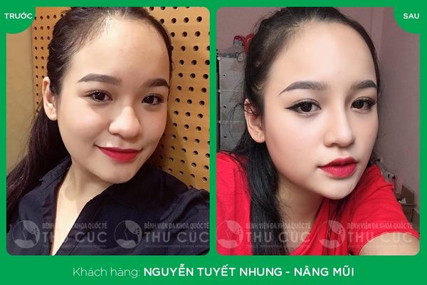 Công nghệ nâng mũi tại Thu Cúc mang đến sự lột xác rõ rệt cho khách hàng (Lưu ý: Kết quả tùy thuộc vào cơ địa mỗi người)