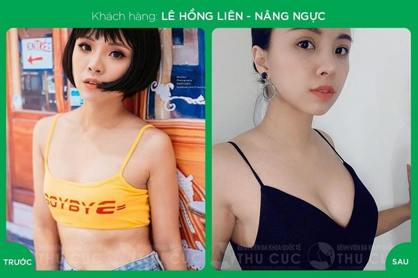 Nâng ngực chảy xệ tại Thu Cúc mang đến hiệu quả thẩm mỹ cao và duy trì dài lâu (Lưu ý: Kết quả tùy thuộc cơ địa mỗi người)
