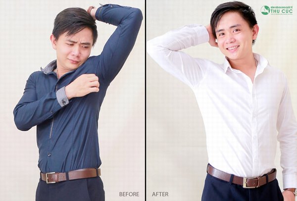 Chỉ với 1 lần điều trị duy nhất bạn sẽ đánh bay được mùi cơ thể (Lưu ý: kết quả tùy thuộc cơ địa mỗi người)