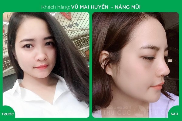 Khách hàng thay đổi diện mạo hoàn hảo sau khi nâng mũi tại Thu Cúc (Lưu ý: Kết quả tùy thuộc cơ địa mỗi người)