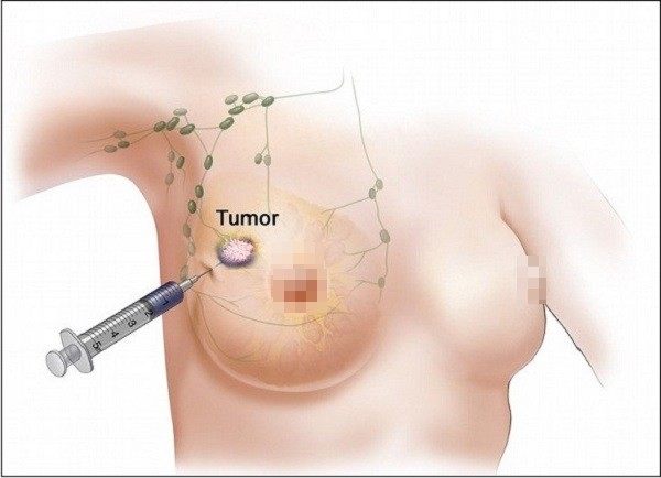 Mỡ tự thân rất an toàn, thân thiện với cơ thể