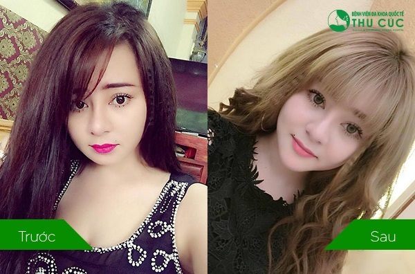 Khách hàng tại Thu Cúc sau khi độn cằm luôn rất hài lòng với kết quả (Lưu ý: Kết quả tùy thuộc cơ địa mỗi người)