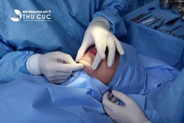 Chi phí phẫu thuật độn cằm tại Thu Cúc rất cạnh tranh với nhiều ưu đãi hấp dẫn