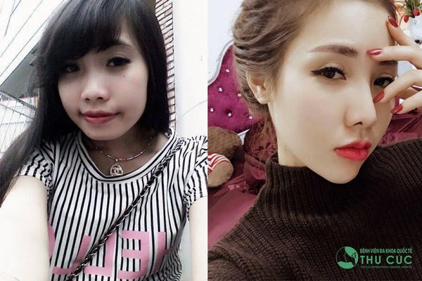 Nâng mũi bọc sụn tại Thu Cúc mang đến sự lột xác gương mặt hoàn hảo cho khách hàng (Lưu ý: Kết quả tùy thuộc cơ địa mỗi người)
