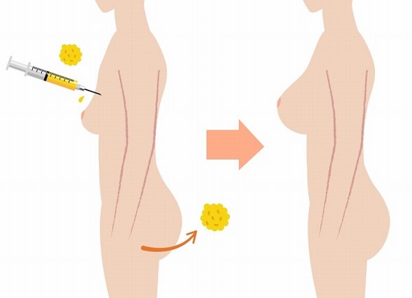 Quy trình nâng ngực bằng mỡ tự thân hoàn toàn không để lại sẹo