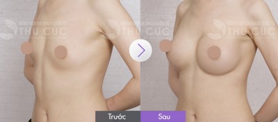 Địa chỉ nâng ngực bằng mỡ tự thân tốt nhất Tp.HCM