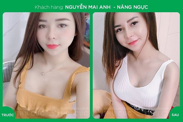 Nhờ sử dụng các loại túi ngực hiện đại, chị em sẽ nhanh chóng sở hữu khuôn ngực căng tròn như ý (Lưu ý: Kết quả tùy thuộc cơ địa mỗi người)