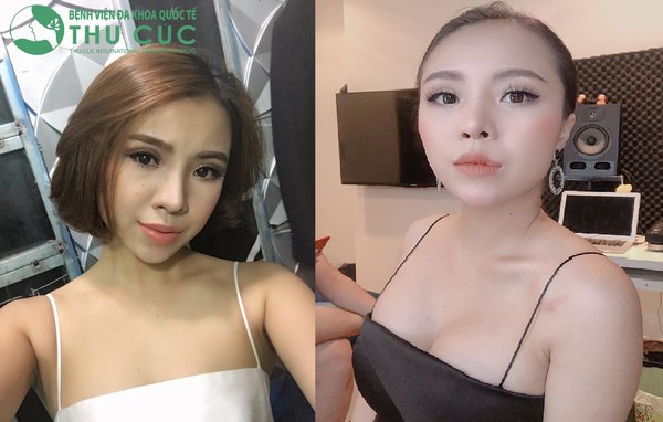 Hàng triệu khách hàng đã lột xác ngoạn mục sau khi nâng ngực tại Thu Cúc (Lưu ý: Kết quả tùy thuộc cơ địa mỗi người)